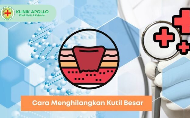 Begini Cara Menghilangkan Kutil Besar