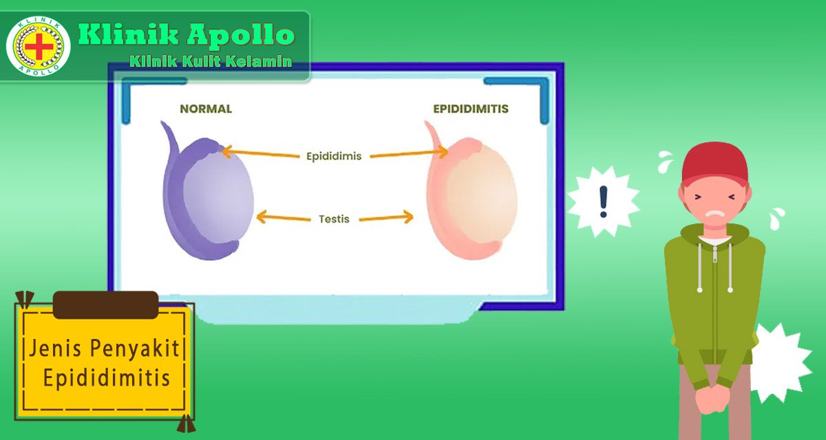 Jenis Penyakit Epididimitis Klinik Apollo Jakarta