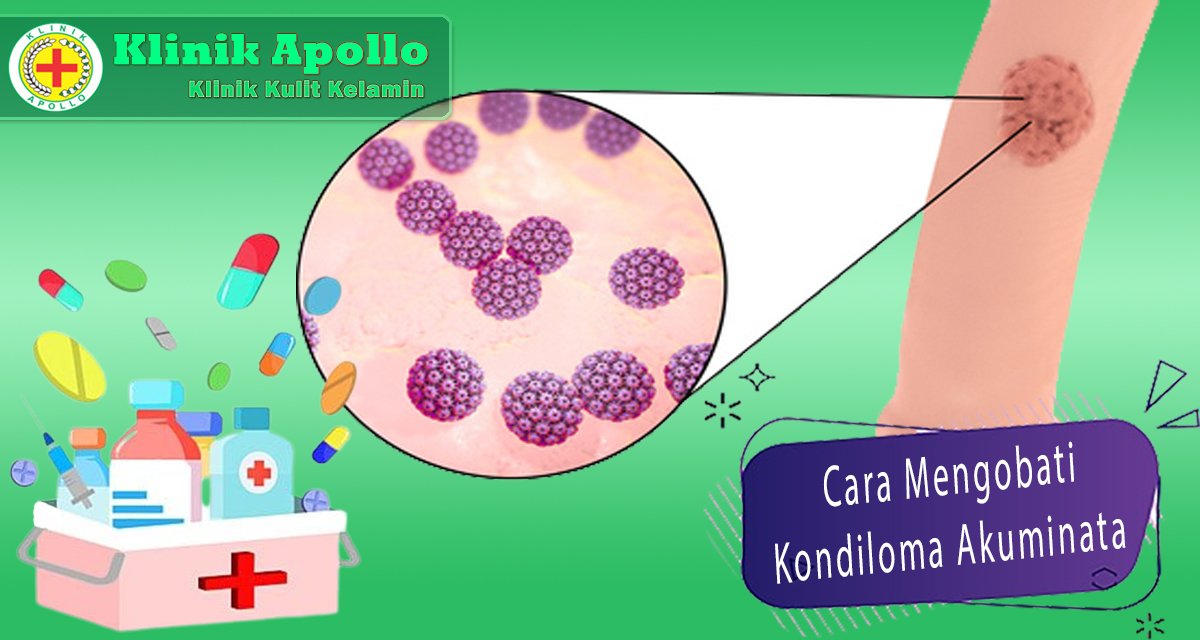 Cara Mengobati Kondiloma Akuminata