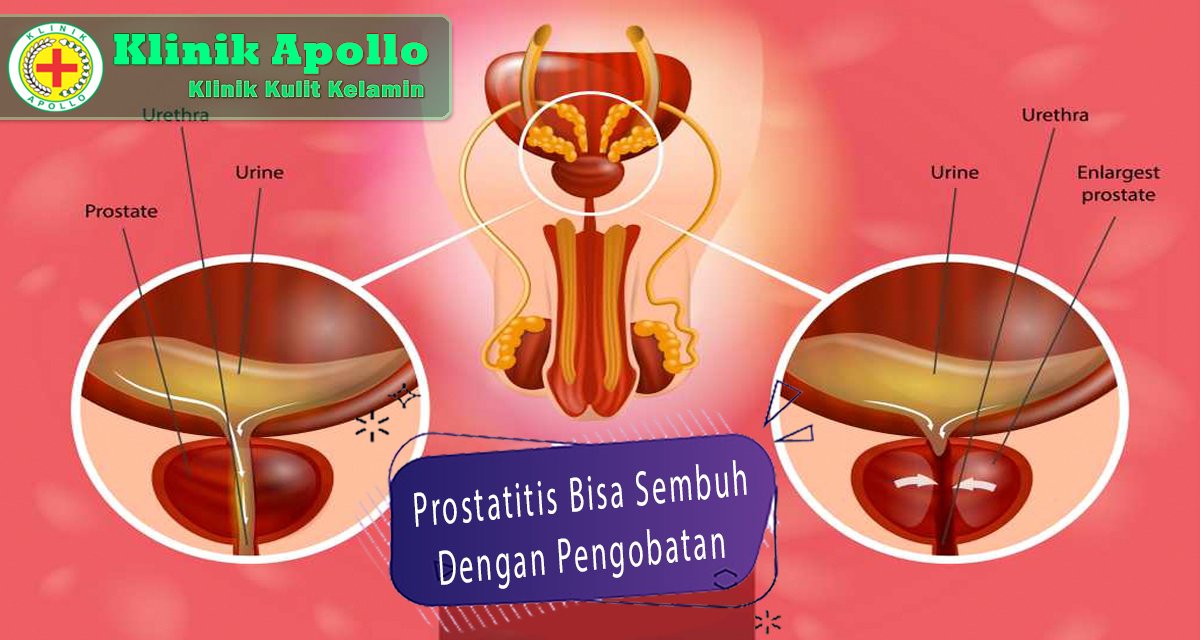 Prostatitis Bisa Sembuh Dengan Pengobatan