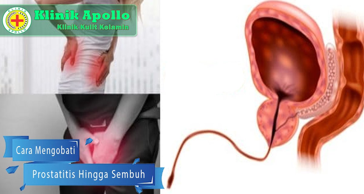 Cara Mengobati Prostatitis Hingga Sembuh