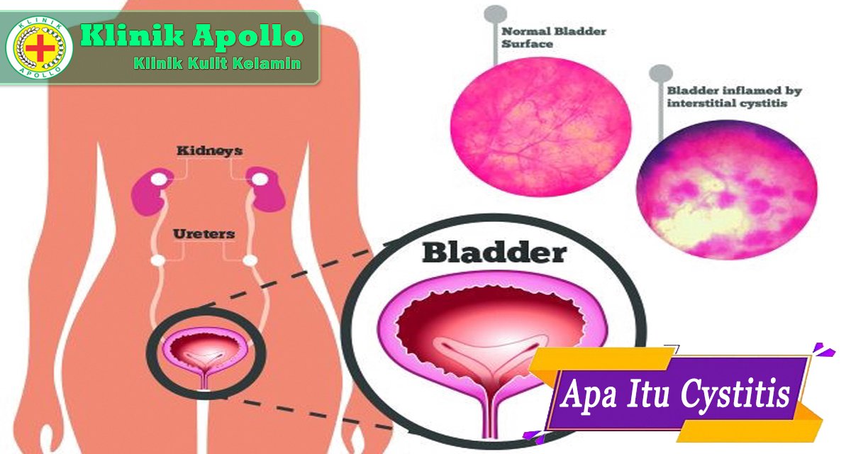 apa itu cystitis