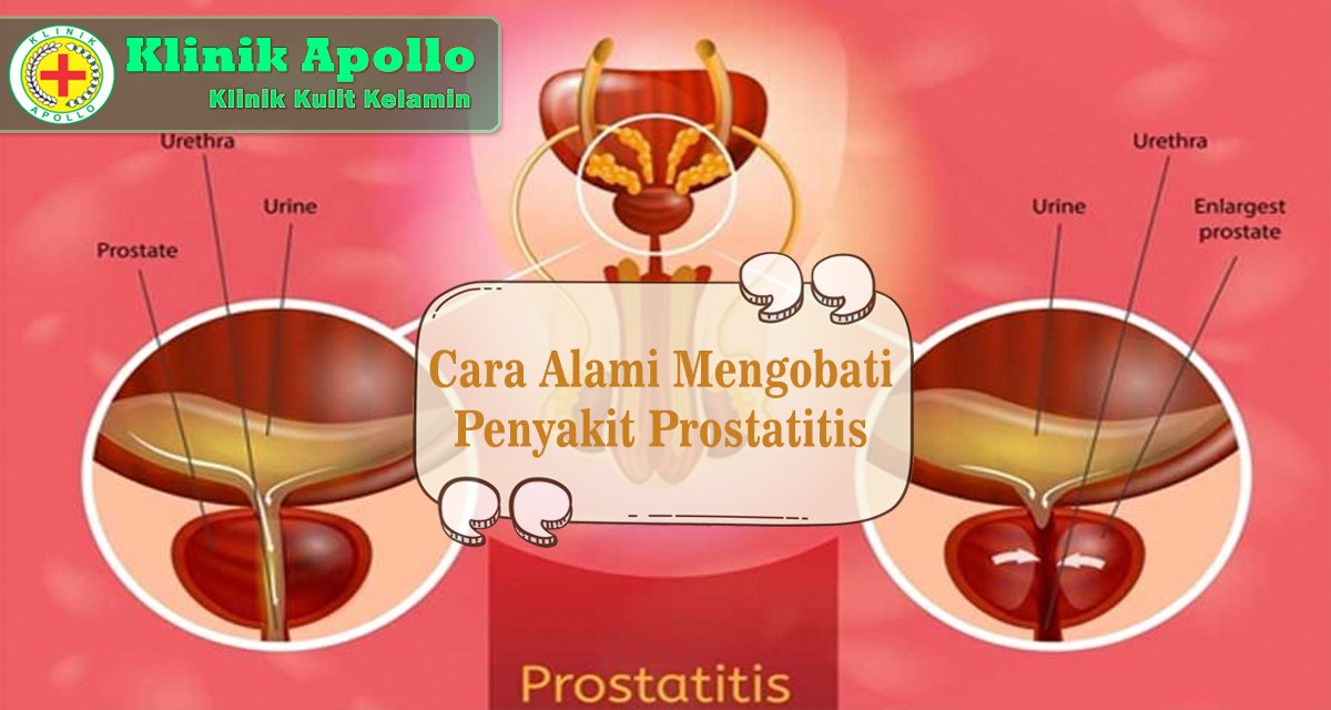 Cara Alami Mengobati Penyakit Prostatitis