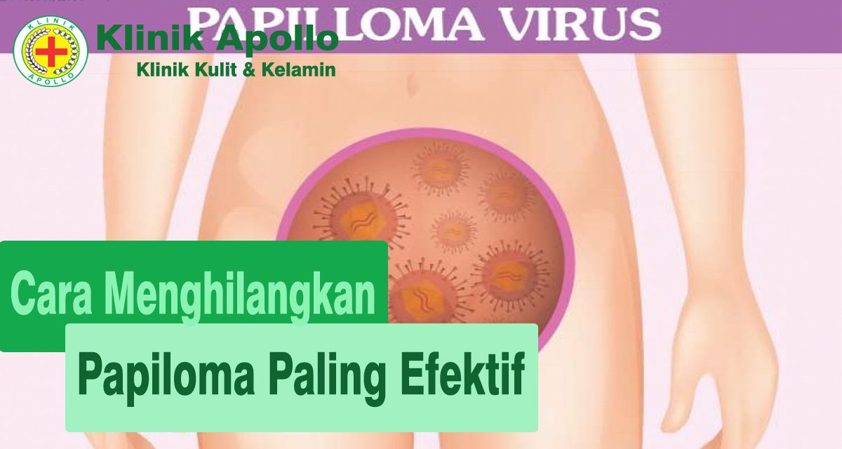 Cara Menghilangkan Papiloma Paling Efektif