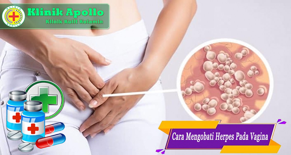 Cara Mengobati Herpes Pada Vagina