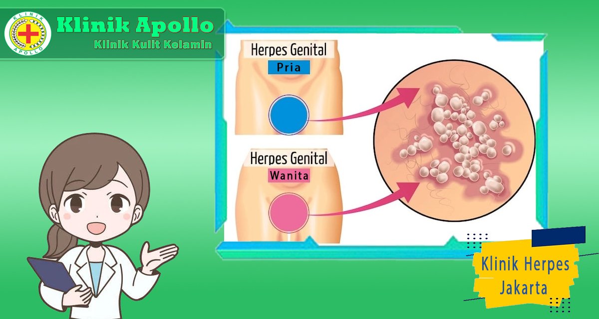 Herpes dapat diobati dan disembuhkan jika ditangani sejak awal.