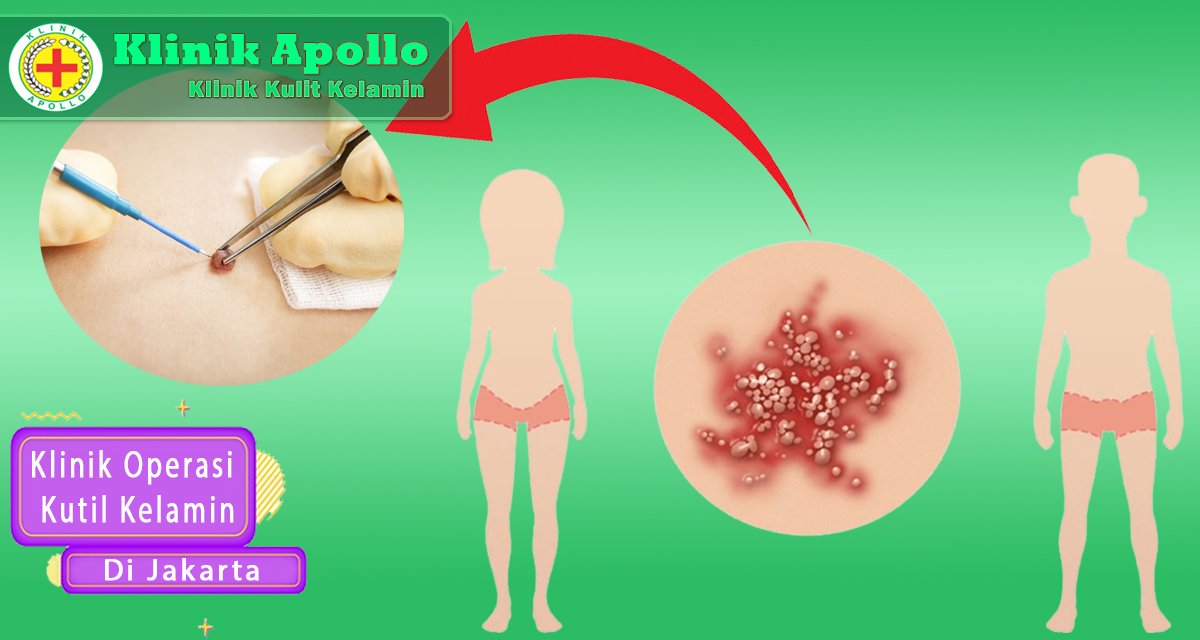 Operasi kutil kelamin dapat dilakukan di Klinik Apollo dengan dokter ahli.