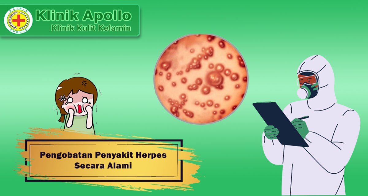 Obat Herpes Alami Menurut Dokter