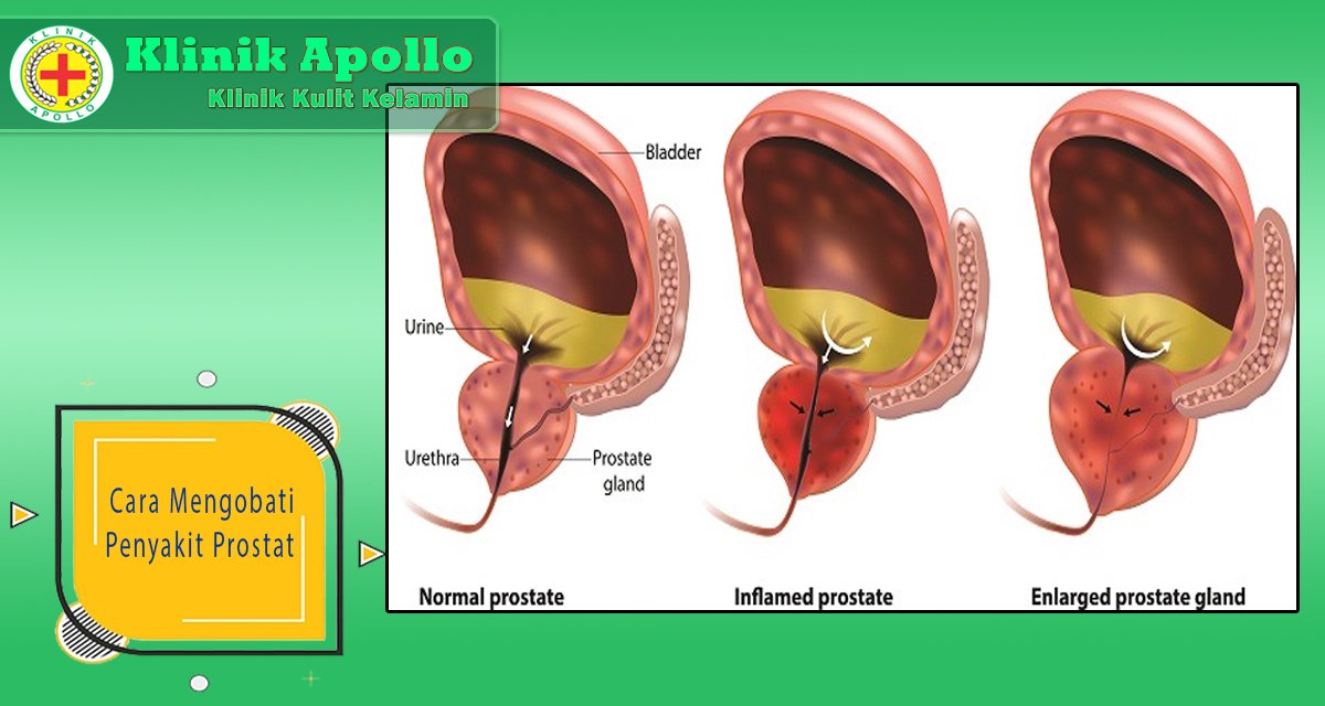 Cara Mengobati Penyakit Prostat