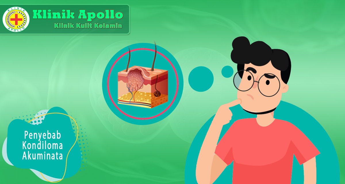 PENYEBAB KONDILOMA AKUMINATA