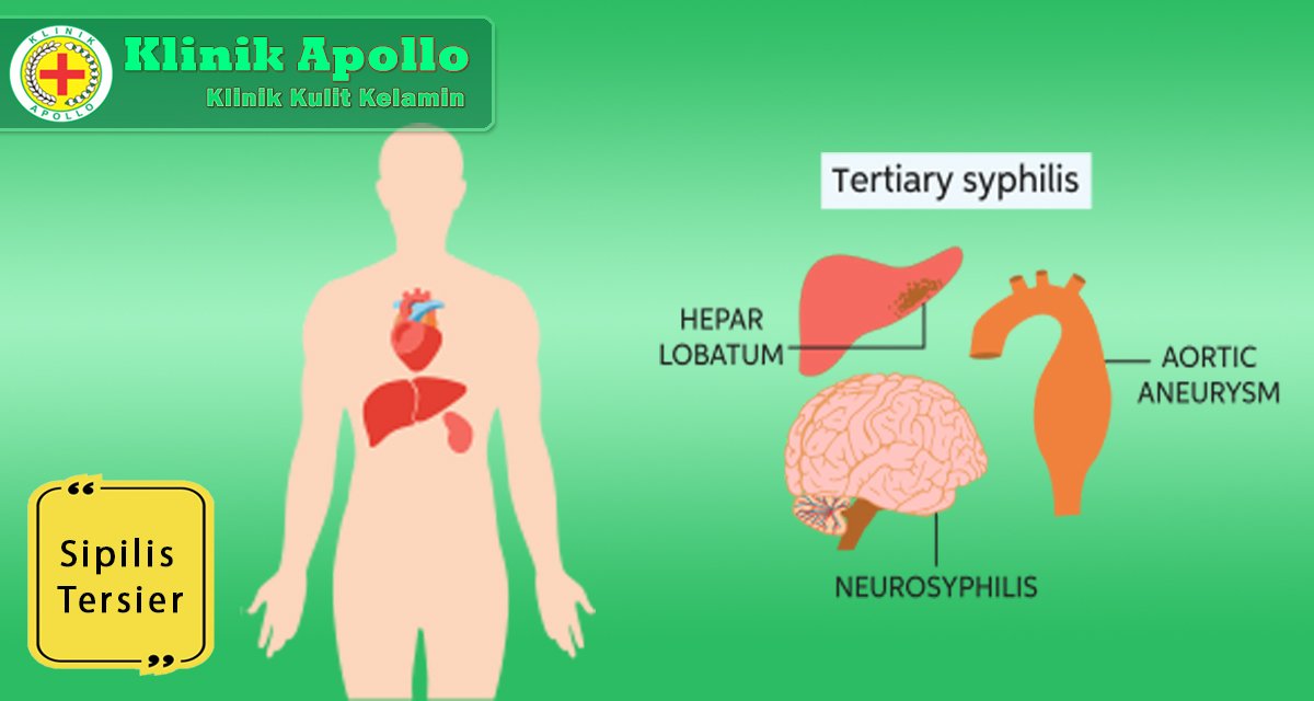 sifilis tersier