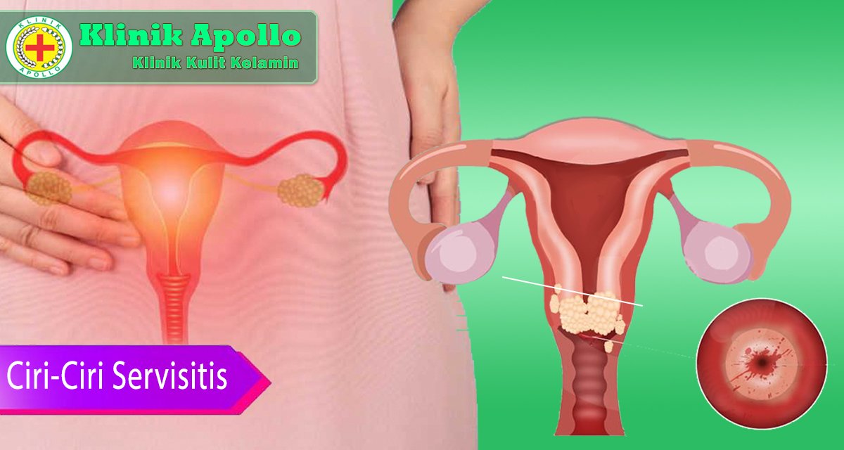 Servisitis dapat disembuhkan dengan pengobatan dengan dokter ahli di Klinik Apollo.
