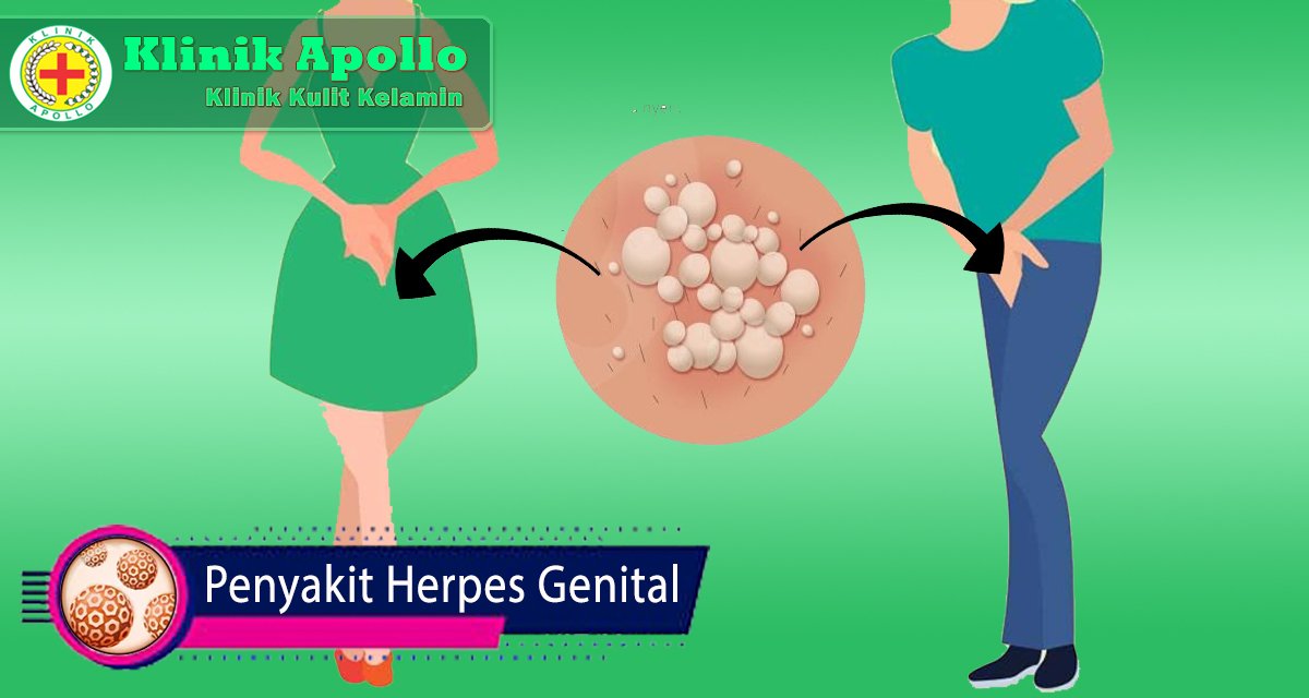 Penyakit Herpes Genital