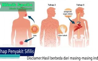 Tahap Penyakit Sifilis