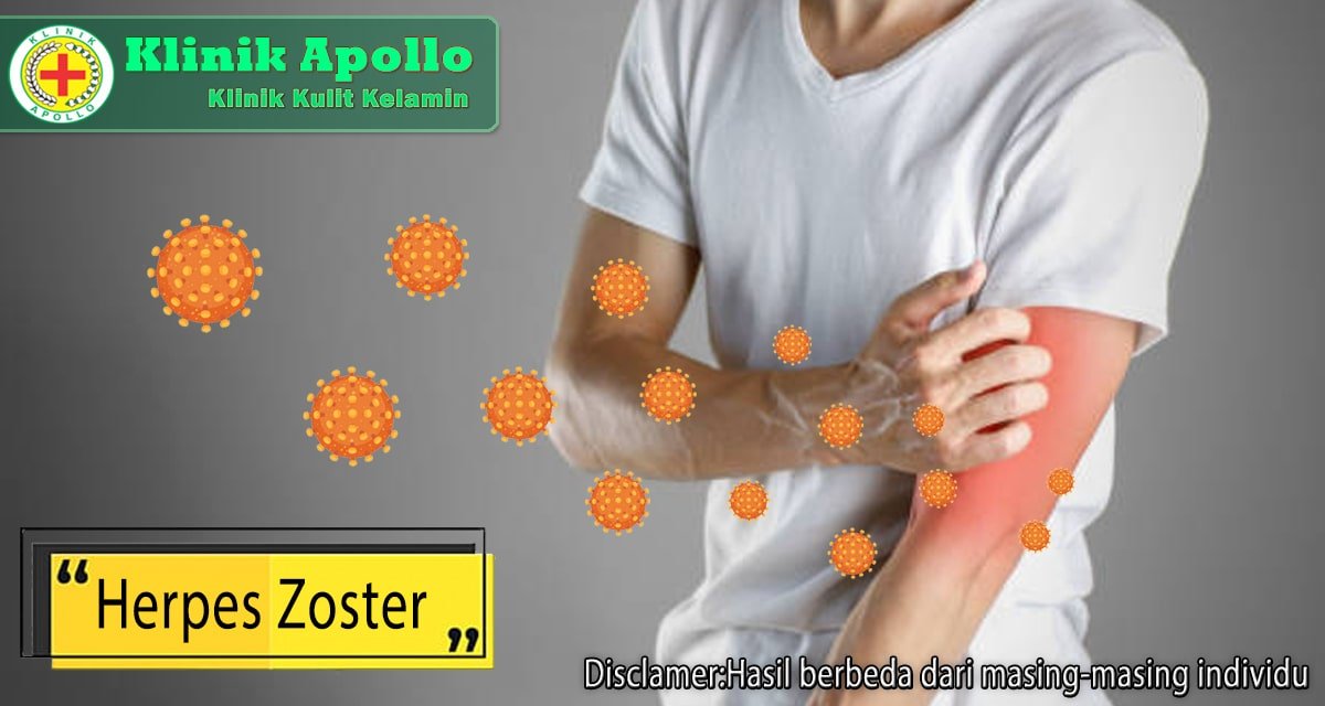 Atasi Ruam Akibat Herpes Zoster: Diagnosis dan Pengobatan
