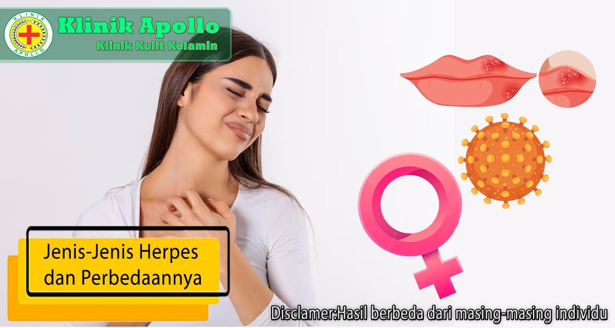 Sebelum melakukan pengobatan, ketahui jenis-jenis herpes dan perbedaannya.