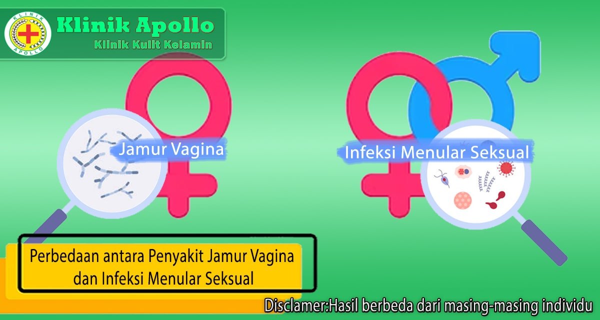 Perbedaan Antara Penyakit Jamur Vagina Dan Ims Klinik Apollo Jakarta