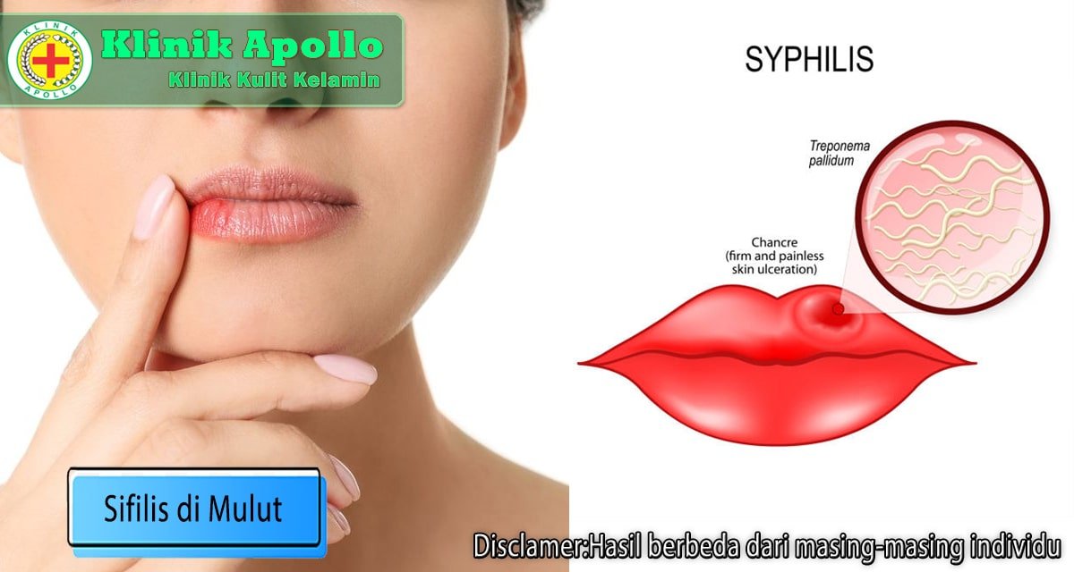 Sifilis di Mulut