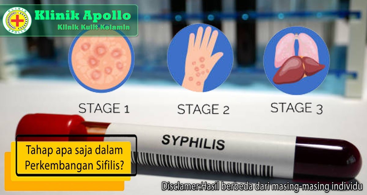 Sifilis adalah penyakit menular yang harus mendapat penanganan di Klinik Apollo.