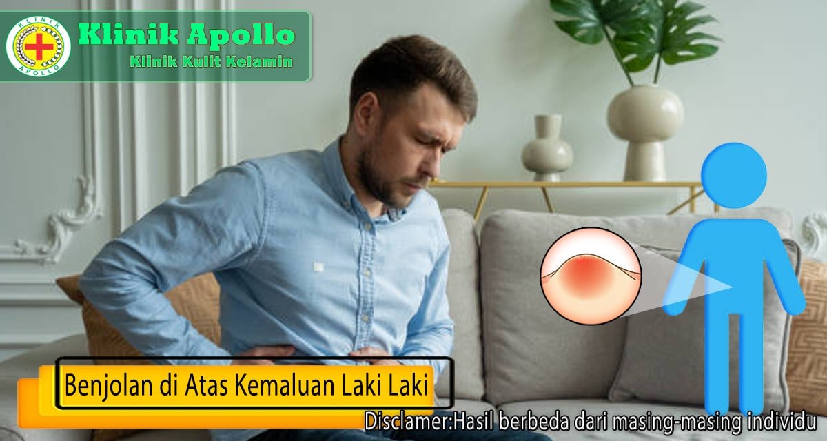 Ilustrasi Benjolan di Atas Kemaluan Laki Laki