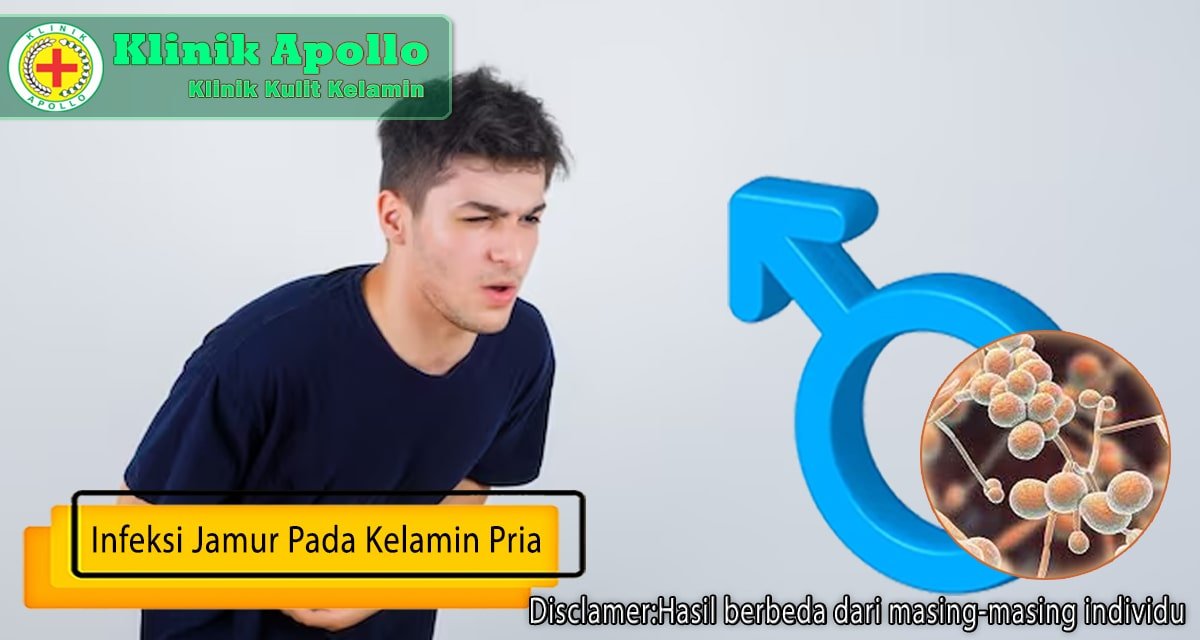 Infeksi Jamur Pada Kelamin Pria Remaja Klinik Apollo Jakarta