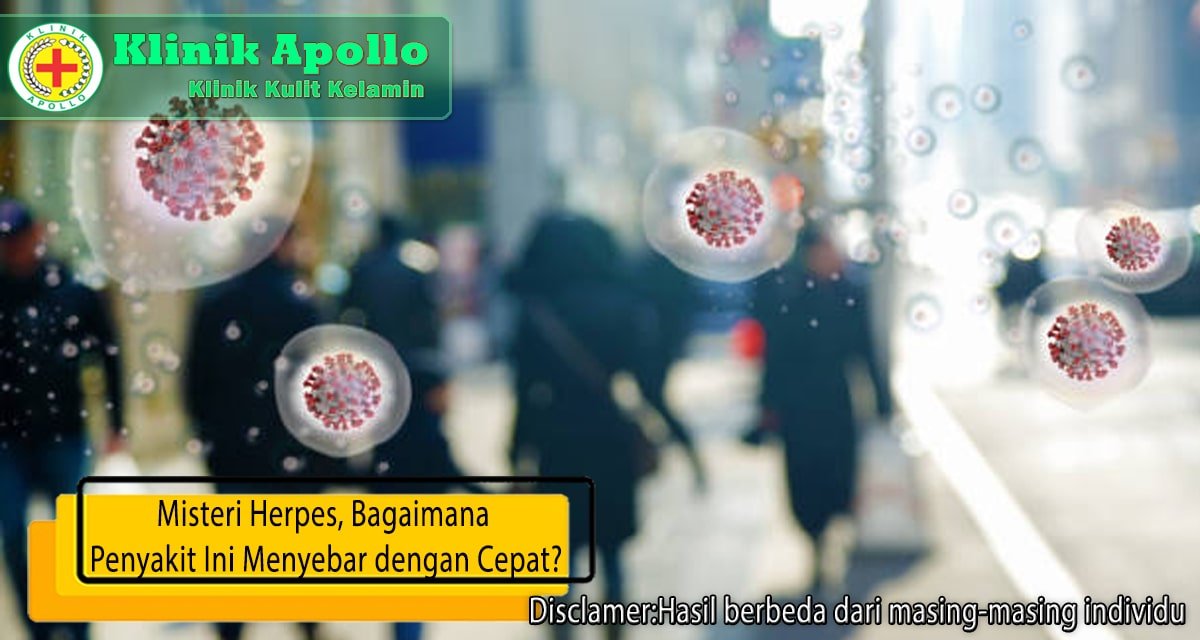 Selalu hubungi dokter untuk penanganan lengkap mengenai herpes di Klinik Apollo.