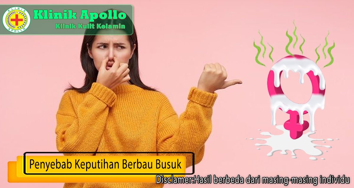 Segera hubungi dokter ahli di Klinik apollo untuk melakukan pemeriksaan keputihan berbau busuk.