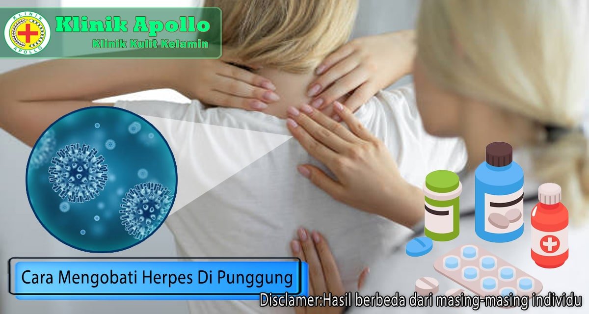 Dijamin Sembuh, Begini Cara Mengobati Herpes di Punggung!