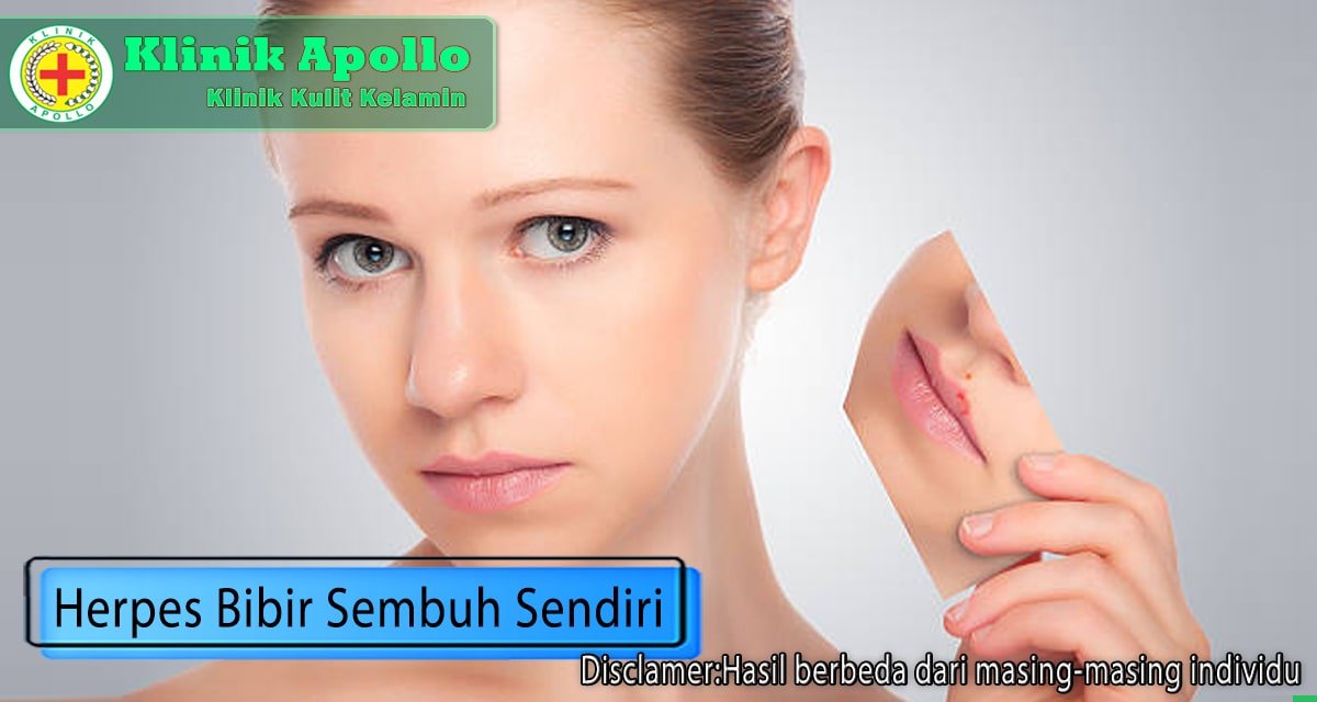 Herpes pada Bibir, Apakah Penyakit Ini Bisa Sembuh Sendiri?