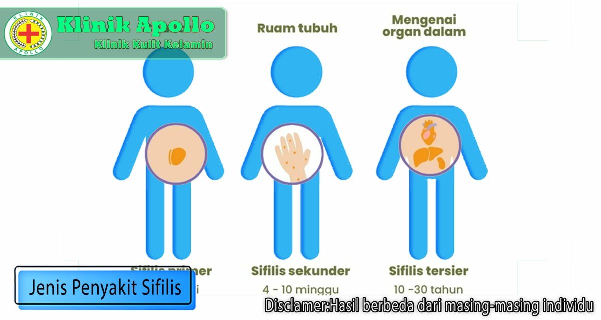 Beragam Dan Berbahaya Inilah 4 Jenis Sifilis Yang Harus Dipahami