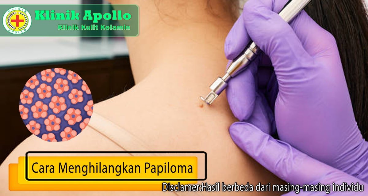 Konsultasikan dengan dokter ahli mengenai cara menghilangkan papiloma dengan cara yang mudah.