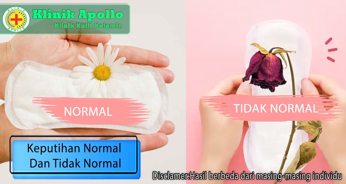 Keputihan Normal Dan Tidak Normal Perbedaan Dan Pengobatan Klinik