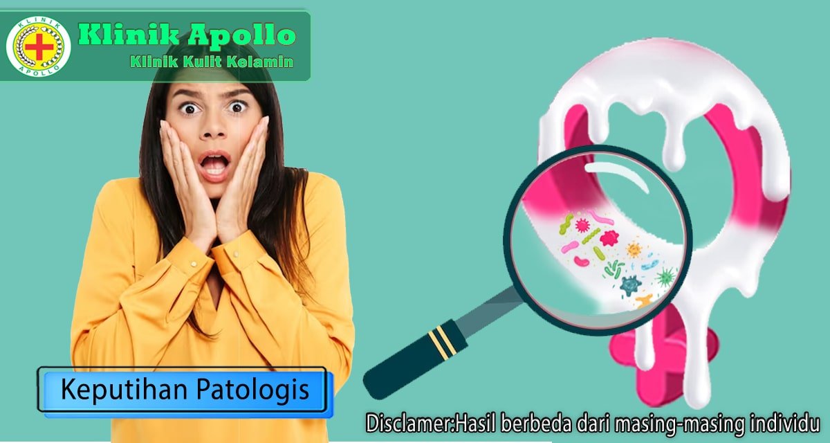 Keputihan Patologis: Penyebab, Ciri-Ciri, dan Pengobatannya
