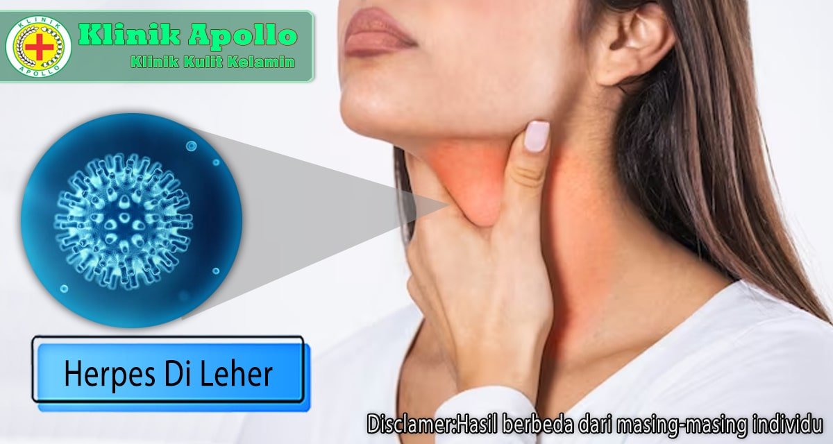 Terganggu Herpes di Leher? Kenali Gejala dan Cara Mengatasinya
