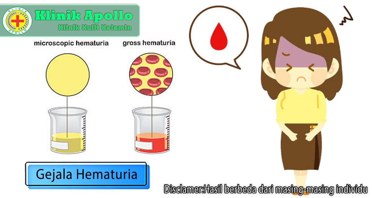 Tidak Normal, Berikut 7 Gejala Hematuria yang Harus Diketahui