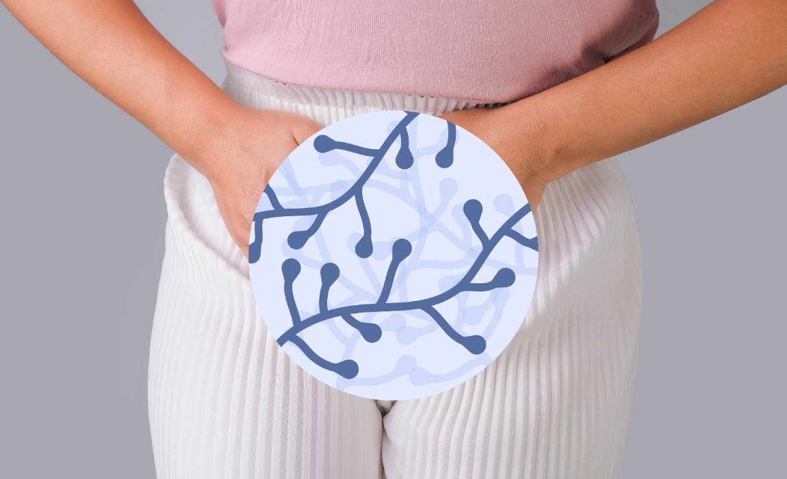 Ilustrasi Penyebab Infeksi Jamur pada Organ Kelamin Wanita