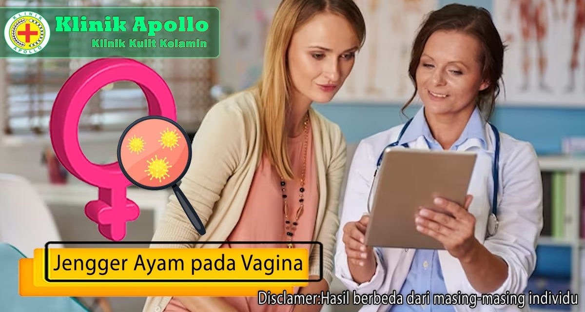 Penanganan untuk jengger ayam pada vagina harus dilakukan secara langsung oleh dokter ahli.