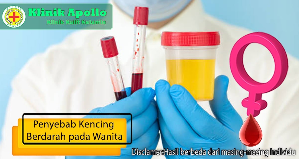 Ketahui penyebab kencing berdarah pada wanita dengan konsultasi dokter ginekologi.