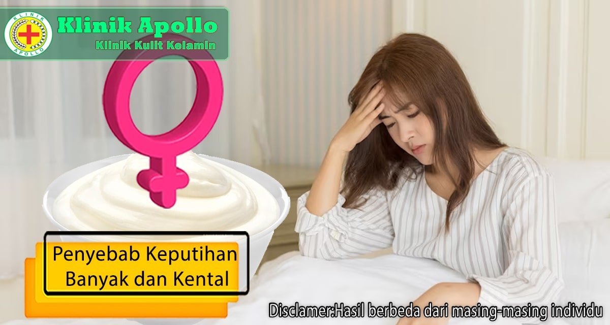 Ilustrasi Penyebab Keputihan Banyak dan Kental