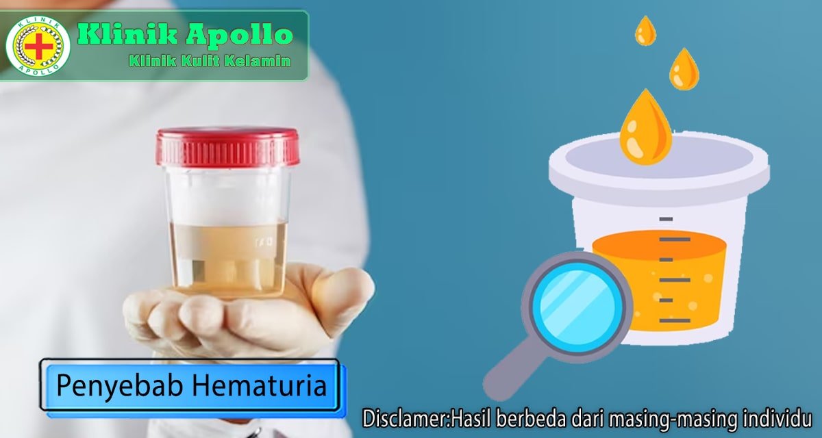 Penyebab Hematuria, Mulai dari Infeksi Saluran Kemih hingga Cedera