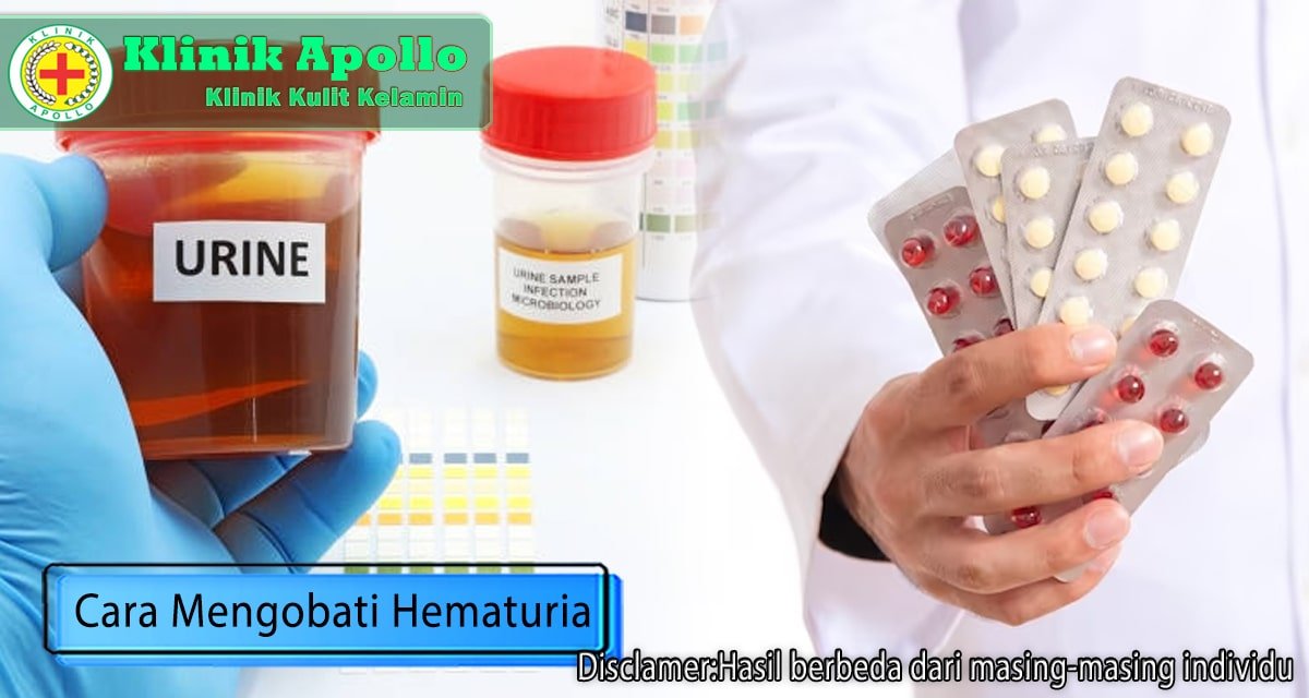 Terganggu karena Hematuria? Begini Cara Mengobati Masalah Ini