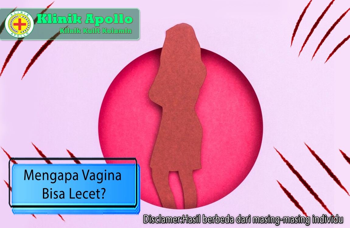 Ilustrasi Mengapa Vagina Bisa Lecet?