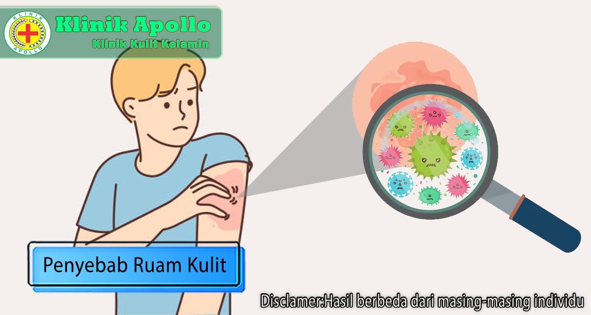 4 Penyebab Munculnya Ruam Kulit, dari Dermatitis hingga Herpes