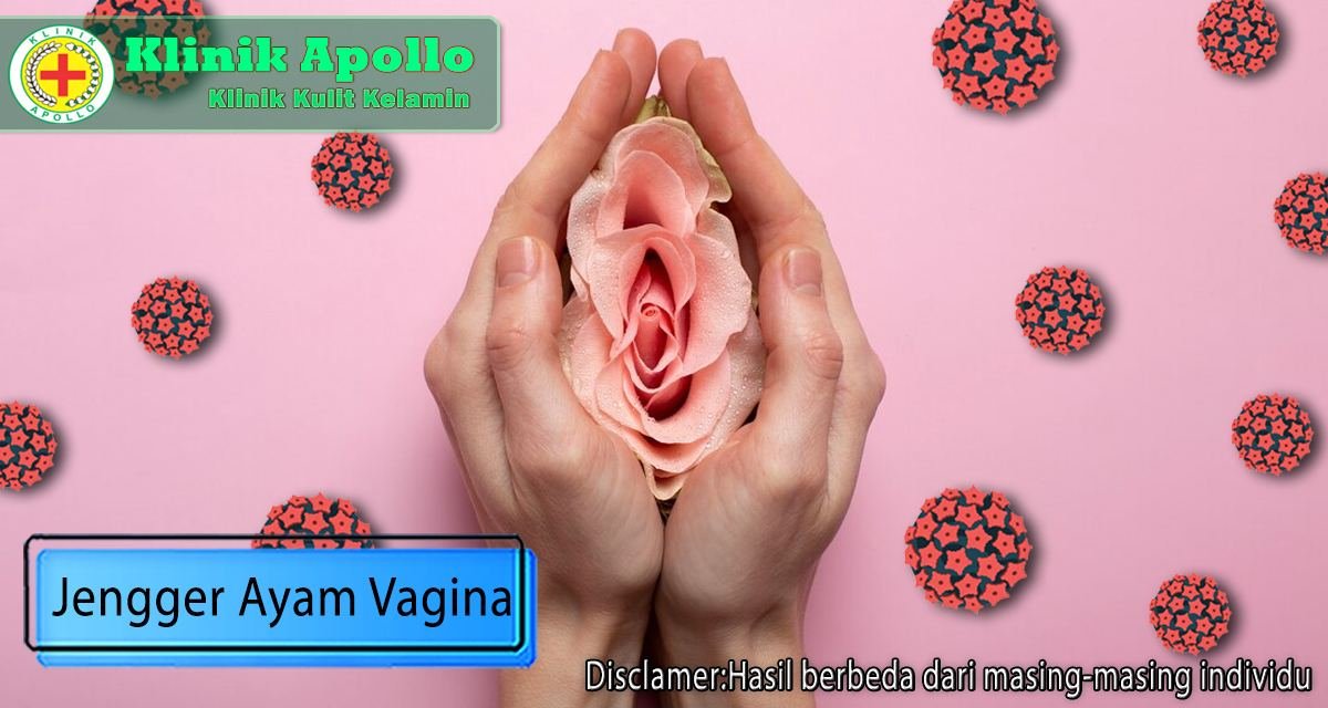 Jengger ayam vagina dapat disembuhkan jika melakukan penanganan sejak dini di Klinik Apollo Jakarta.