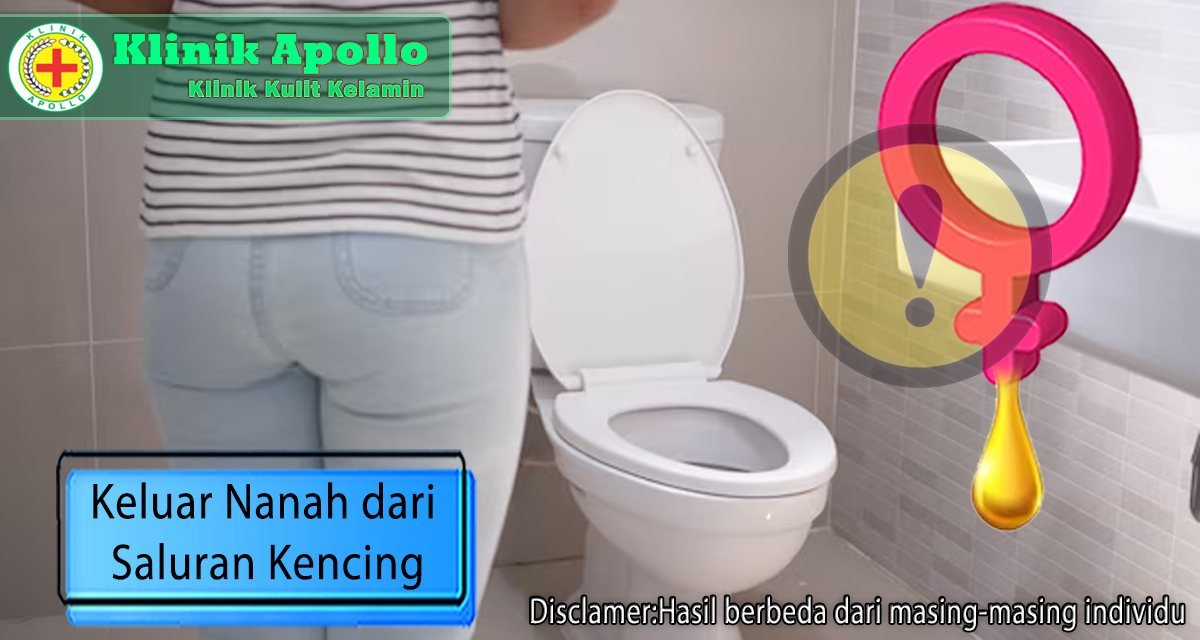 Saat Anda mengalami keluar nanah dari saluran kemih, segera hubungi dokter ahli di Klinik Apollo.