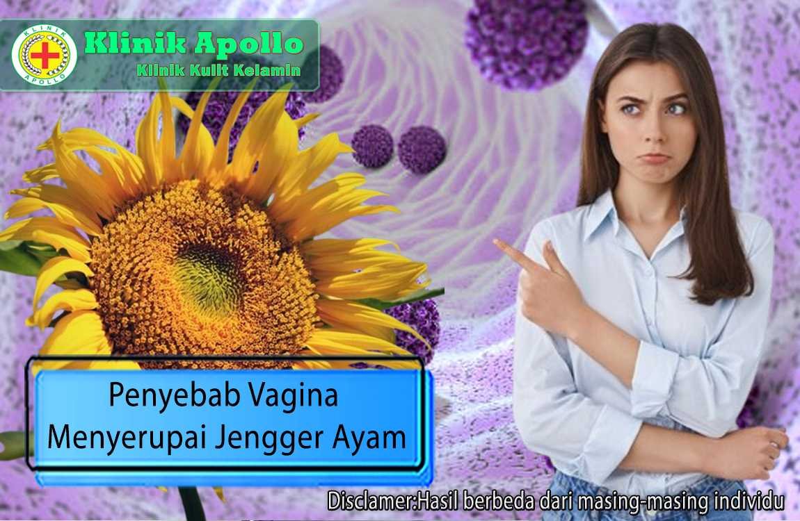 Ilustrasi Penyebab Vagina Menyerupai Jengger Ayam