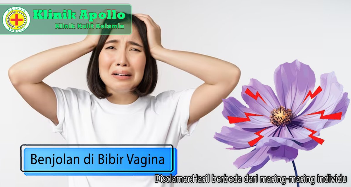 Benjolan di Bibir Vagina