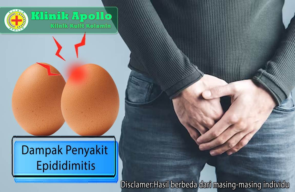 Tanpa pengobatan yang tepat, dampak penyakit epididimitis dapat terjadi.