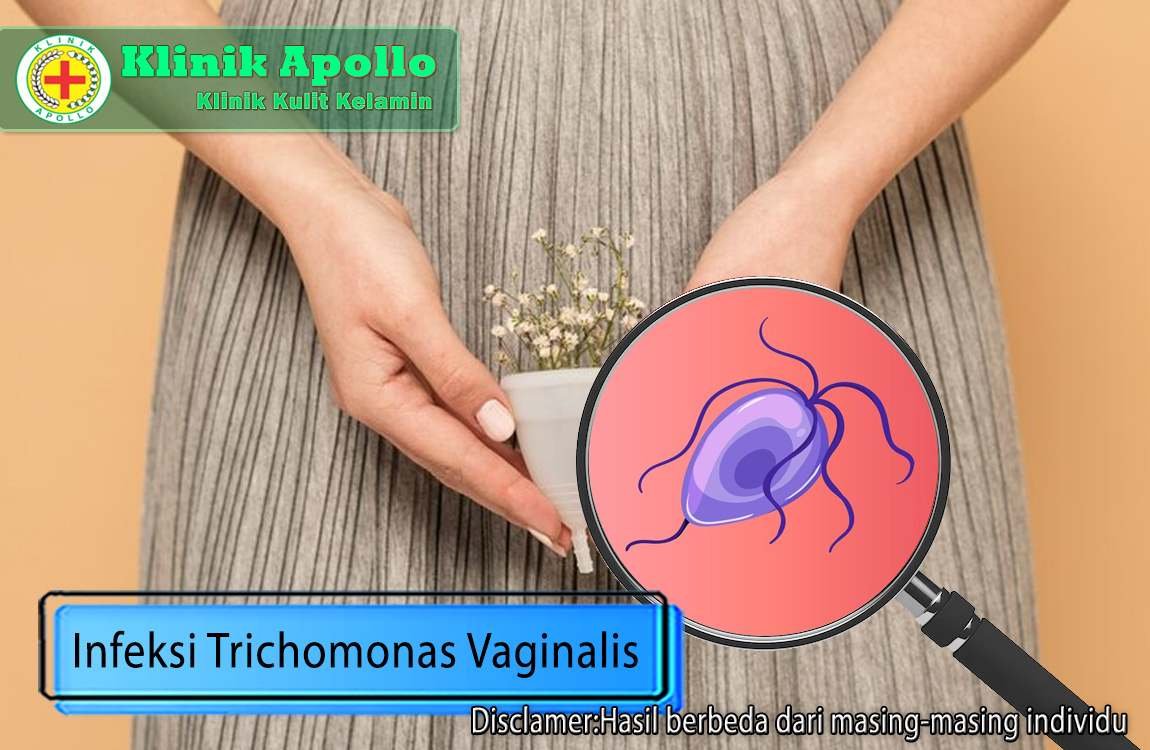 Jangan khawatir jika mengalami infeksi trichomonas vaginalis, hubungi dokter ahli di Klinik Apollo.