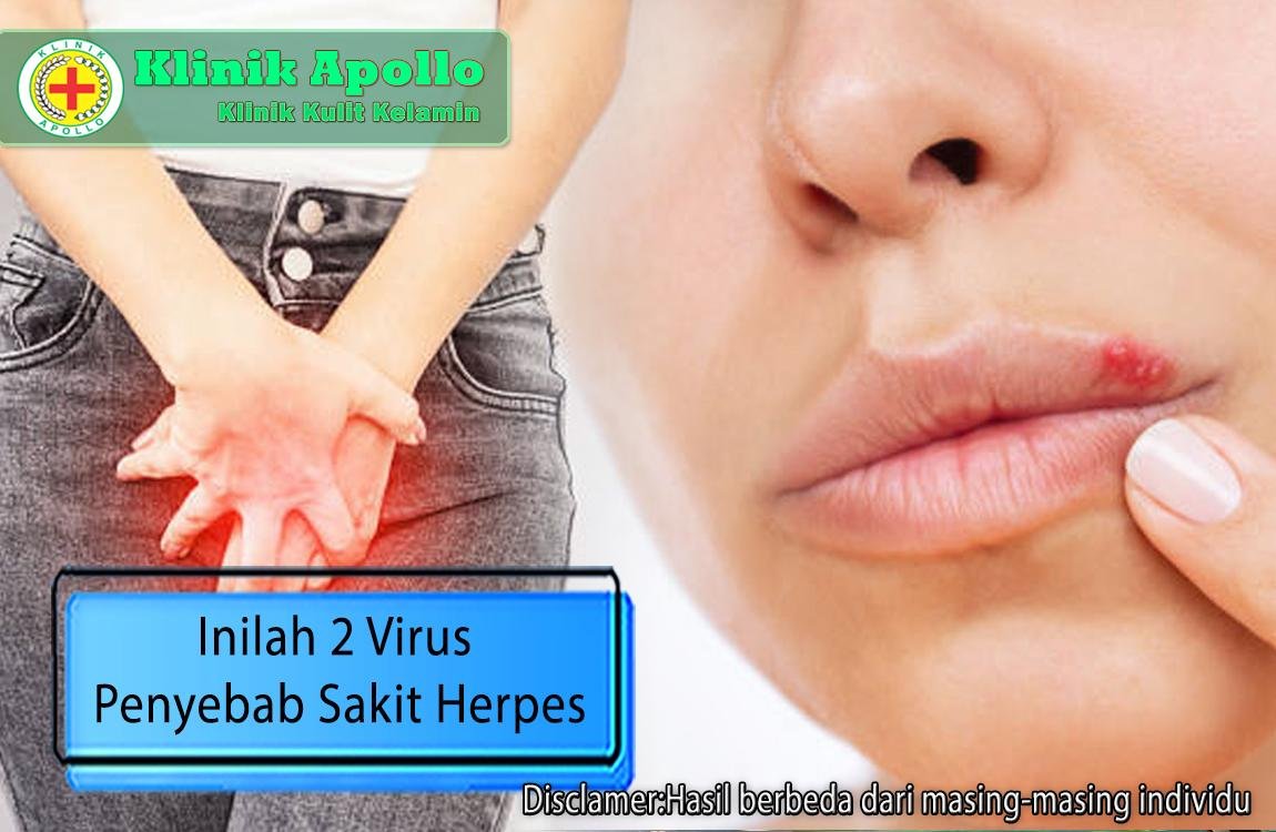 Lakukan pemeriksaan dan inilah 2 virus penyebab sakit herpes yang perlu Anda waspadai.